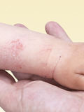 Картинка-анонс к статье Виды аллергии на коже