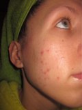 Картинка-анонс к статье Как избавиться от аллергии на лице