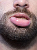 Картинка-анонс к статье Аллергия на губах и во рту