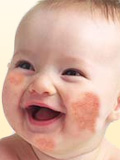 Картинка-анонс к статье Лечение аллергии на щеках у детей
