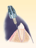 Картинка-анонс к статье Аллергия на анестетики в стоматологии