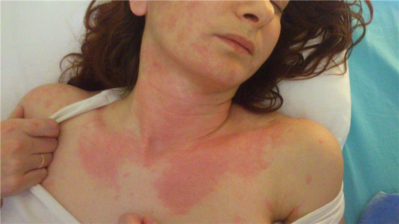 Признаки тепловой крапивницы на шее и груди