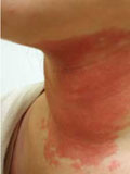 Картинка-анонс к статье Симптомы и лечение псориаза на шее