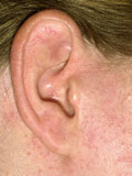 Картинка-анонс к статье Лечение экземы в ушах