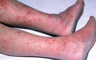 Венозный дерматит на ногах лечение
