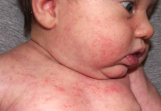 Проявления аллергической реакции на говядину у младенца
